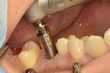 パンチングによる歯肉の剥離